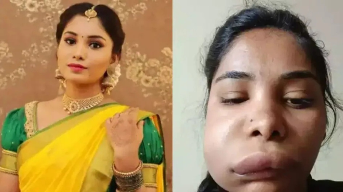 सर्जरीले अभिनेत्रीको अनुहार नै बिग्रियो